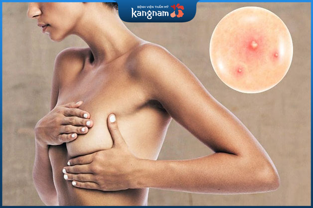 Vùng đầu ngực nổi nhiều trong chị em trong giai đoạn mang thai