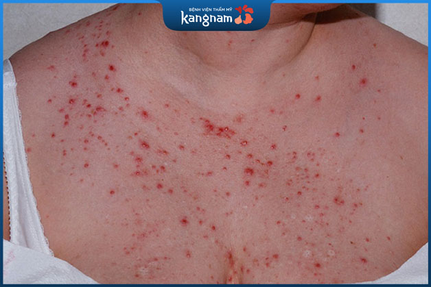 Nội tiết tố biến đổi khiến mụn ở vùng ngực mãi không khỏi