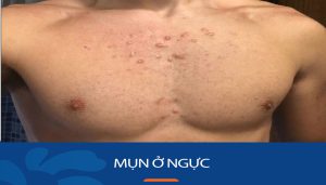 Mụn ở ngực: Bí quyết loại bỏ mụn ở ngực tận gốc
