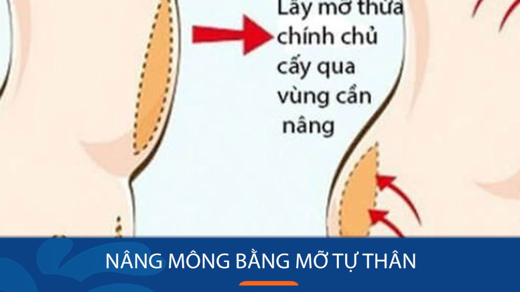 Nâng mông bằng mỡ tự thân? Ưu điểm khi thực hiện tại kangnam