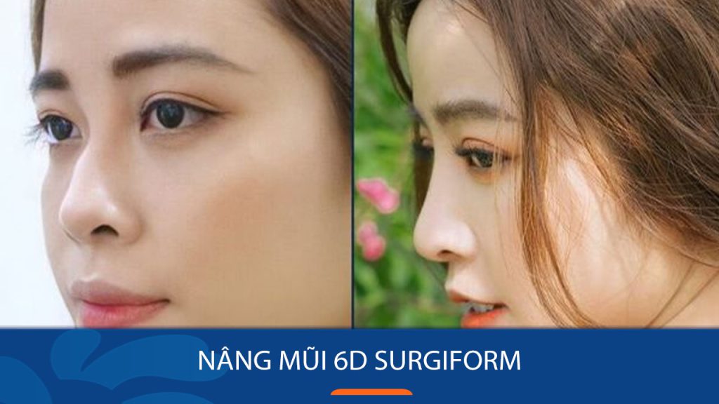 Nâng mũi 6D Surgiform là gì? Cấu tạo, ưu điểm và điểm khác biệt