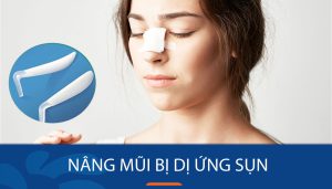 Nâng mũi bị dị ứng sụn: 4 Dấu hiệu & Cách khắc phục nhanh