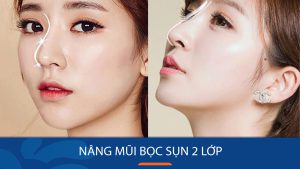 Nâng mũi bọc sụn 2 lớp là gì? Cấu tạo, ưu nhược điểm và ai phù hợp