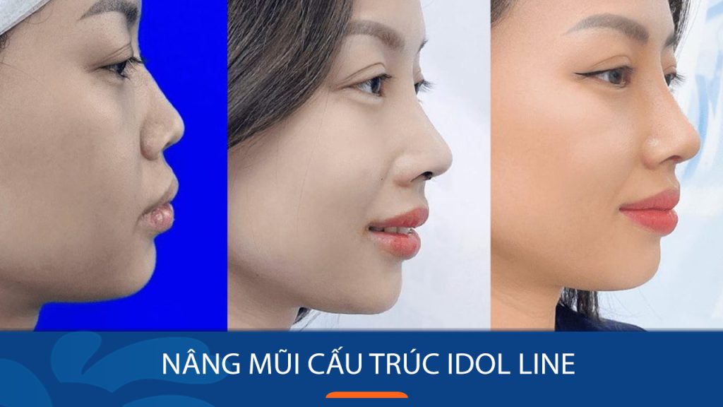 Nâng mũi Idol Line kiêng ăn bao lâu? Hướng dẫn chi tiết từ chuyên gia