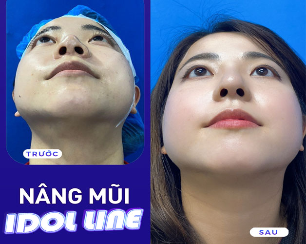 Nâng mũi tại Kangnam mang đến hiệu quả cao