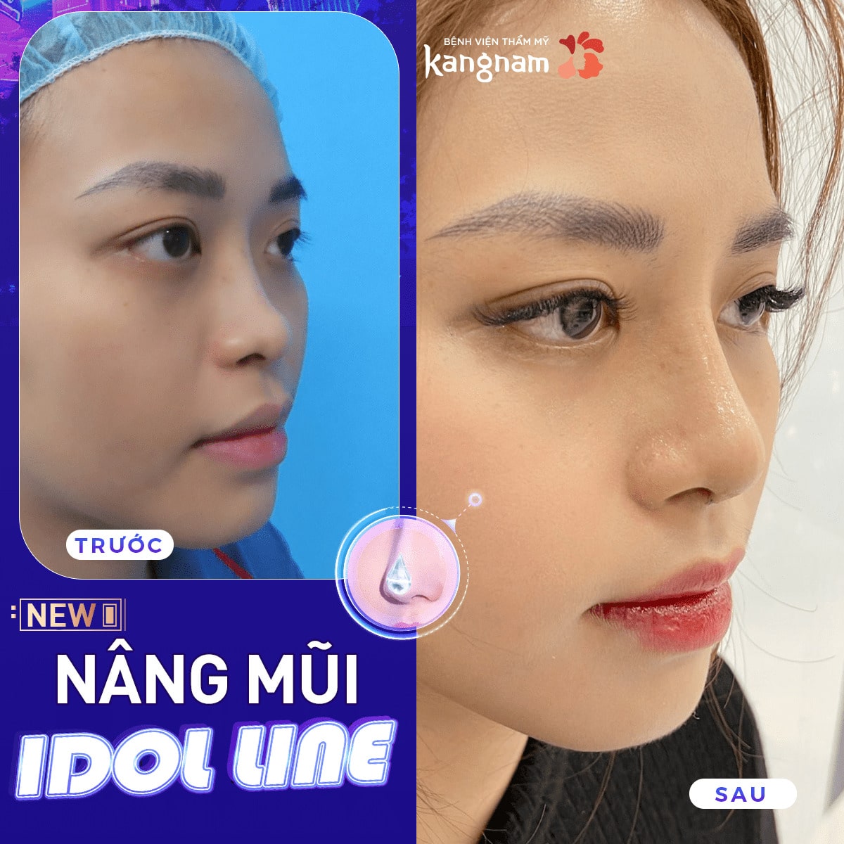 Tái tạo toàn bộ cấu trúc mũi, thiết kế dáng mũi cao tự nhiên