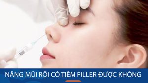 Nâng mũi rồi có tiêm filler được không