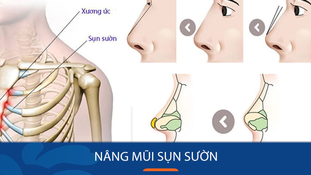 Nâng mũi sụn sườn là gì? Ưu nhược điểm, ai phù hợp và những điều cần biết