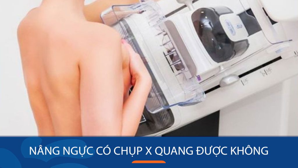 Nâng Ngực Có Chụp X-quang Được Không? Giải Đáp Cụ Thể Từ Bác Sĩ