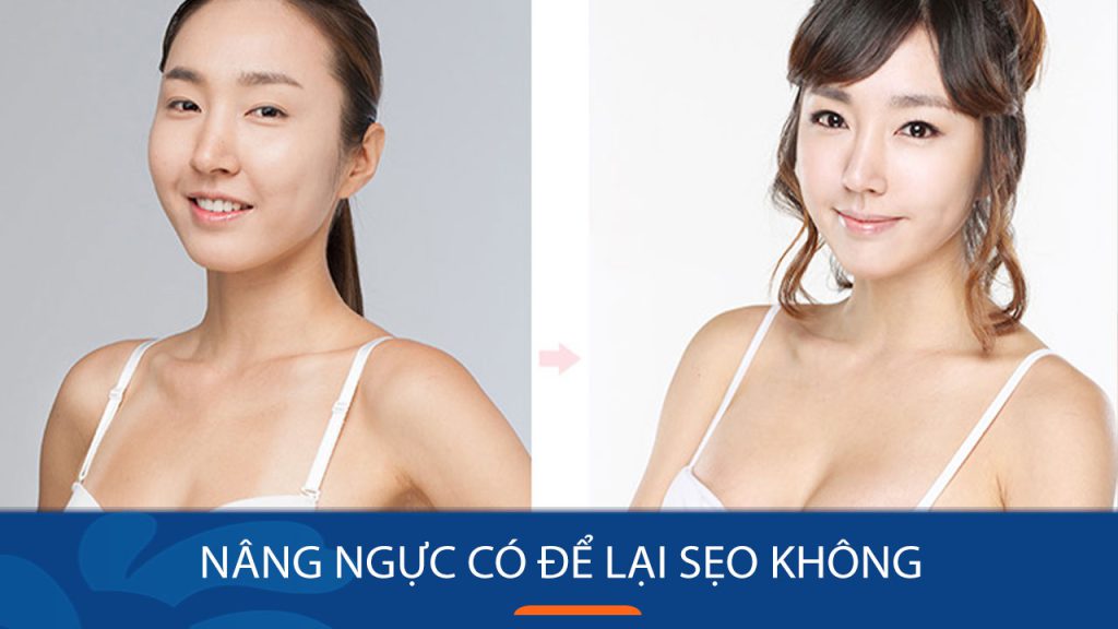 Nâng ngực có để lại sẹo không? Có đáng lo ngại không
