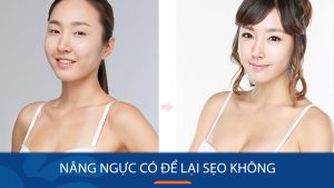 Nâng ngực có để lại sẹo không? Có đáng lo ngại không