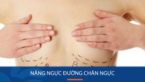 Nâng ngực đường chân ngực