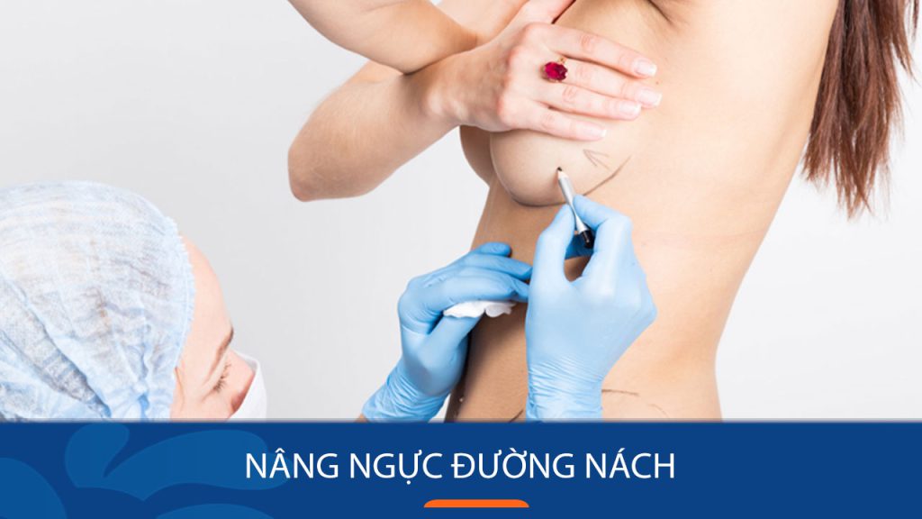 Bác sĩ Kangnam giải đáp về phương pháp nâng ngực đường nách
