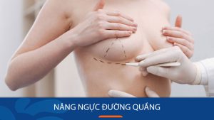 Nâng ngực đường quầng