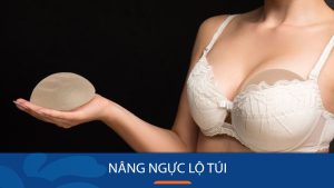 Nâng ngực lộ túi: Biểu hiện và phương pháp khắc phục