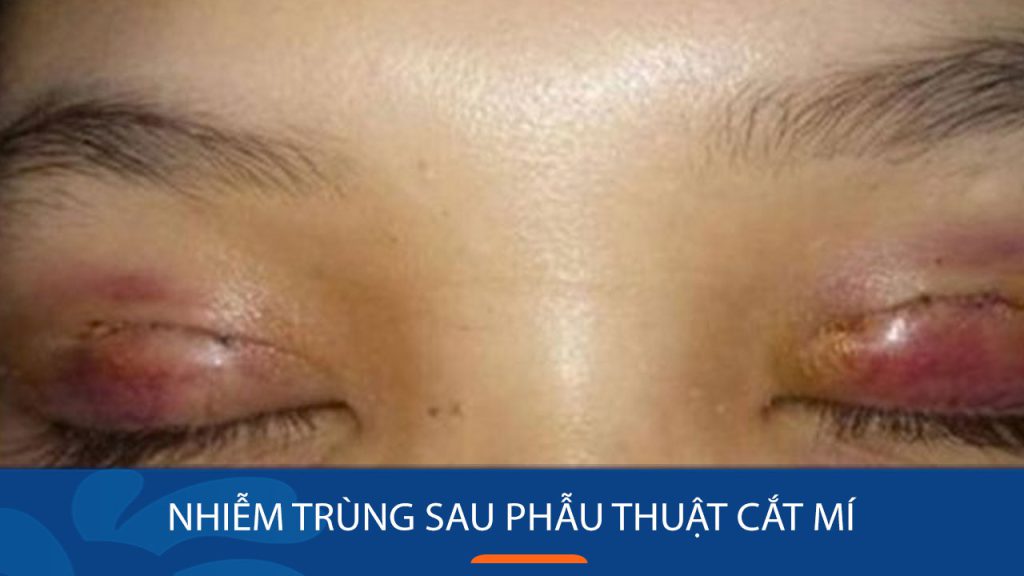 Nhiễm trùng sau cắt mí: Dấu hiệu, nguyên nhân và cách xử lý an toàn