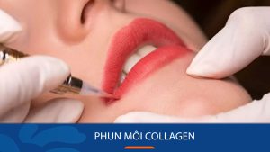 Phun môi Collagen là gì? Bí quyết sở hữu môi căng mọng