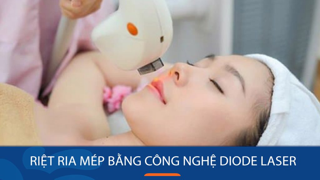 Triệt ria mép Vĩnh Viễn với Diode Laser: Làn Da Mịn Màng, Tự Tin Tỏa Sáng