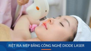 Triệt ria mép Vĩnh Viễn với Diode Laser: Làn Da Mịn Màng, Tự Tin Tỏa Sáng