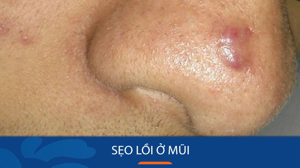 Đánh bay sẹo lồi ở mũi hiệu quả – Bí quyết từ chuyên gia