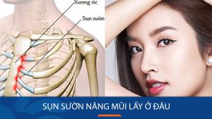 Sụn sườn nâng mũi lấy ở đâu? Vị trí lấy sụn và những điều cần biết
