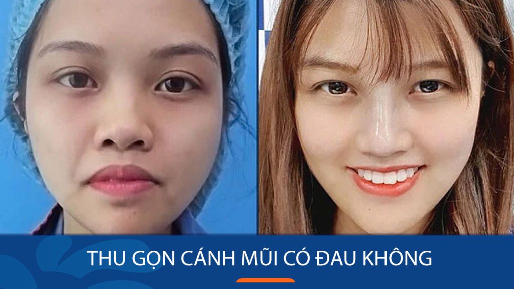 Thu gọn cánh mũi có đau không? Mức độ đau và cách giảm đau hiệu quả