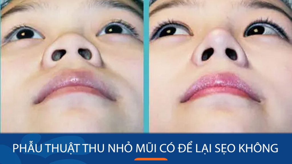 Phẫu thuật thu nhỏ mũi có để lại sẹo không? bác sĩ giải đáp