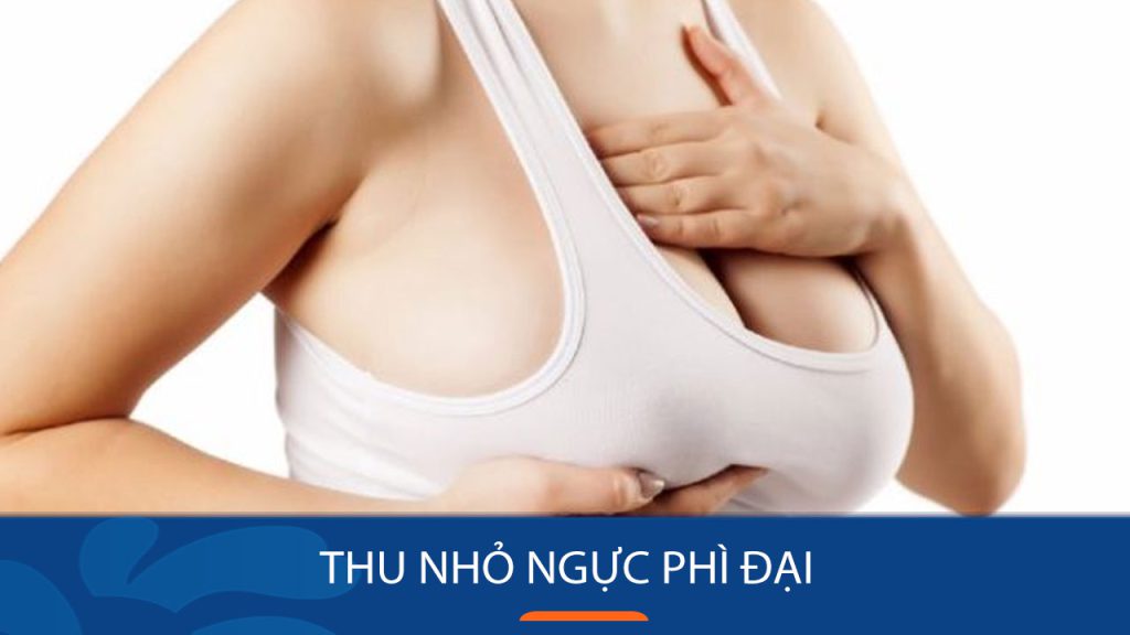 Thu nhỏ ngực phì đại: Giải pháp cho vòng 1 cân đối và tự tin