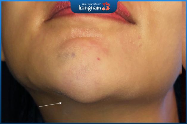 Tiêm cằm bị vón cục