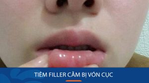 Tiêm filler cằm bị vón cục: Cách khắc phục tình trạng vón cục