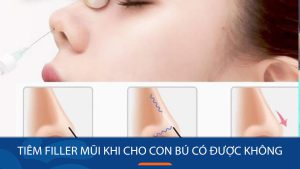 Tiêm filler mũi khi cho con bú có được không