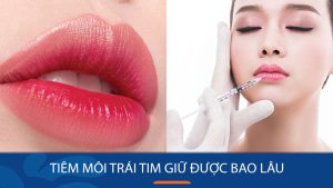 Tiêm filler môi trái tim giữ được bao lâu? Giải đáp thắc mắc từ chuyên gia