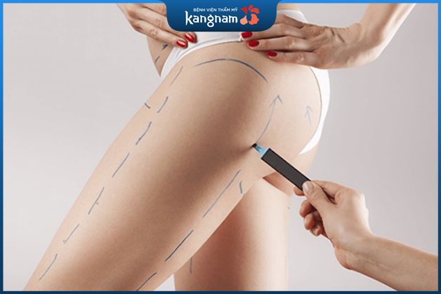 Tiêm tan mỡ hoặc massage RF giảm mỡ vùng đùi