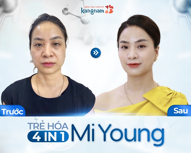 Khách hàng trẻ da 5 tuổi sau khi áp dụng công nghệ trẻ hóa tại Kangnam