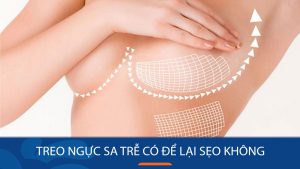 Treo ngực sa trễ có để lại sẹo không, Cách chăm sóc hạn chế sẹo