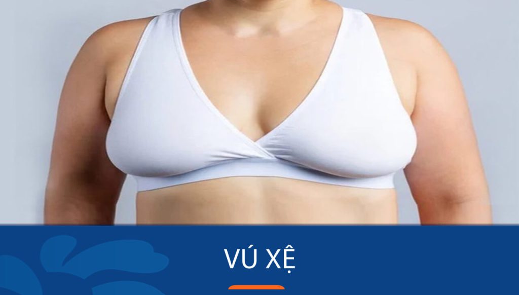 Vú xệ: Nguyên nhân, mức độ và Giải pháp nào cho vòng 1 săn chắc?