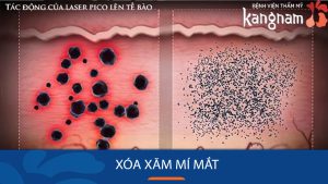 Trường hợp nào cần phải xóa xăm mí mắt? cách xóa xăm mí mắt