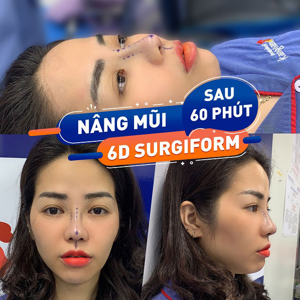 những người có tình trạng mũi không đẹp như mũi tẹt, gồ ghề, đầu mũi to, cánh mũi dày