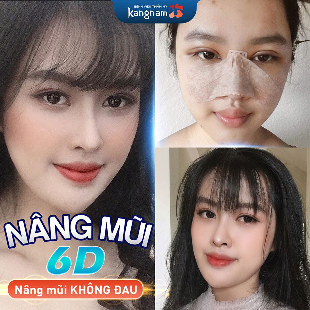 Nâng mũi an toàn, không lộ sụn