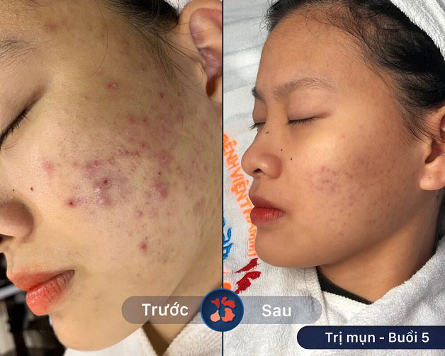 Khách hàng trị mụn sau 5 buổi, giảm thâm và viêm rõ rệt