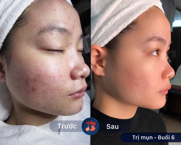 Mụn chai sần, mụn mủ được loại bỏ hoàn toàn