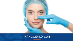 Nâng mũi lòi sụn