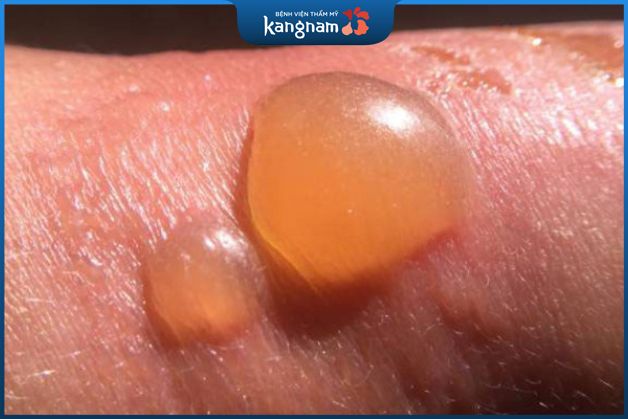 Cẩn thận khi vết bỏng bô bị phồng nước