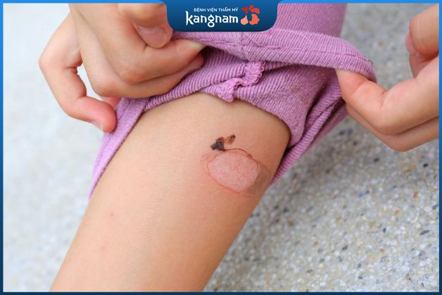 Bỏng bô xe máy là tình trạng khá phổ biến