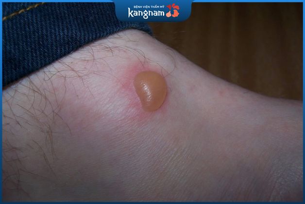 Bỏng bô có 3 cấp độ tổn thương