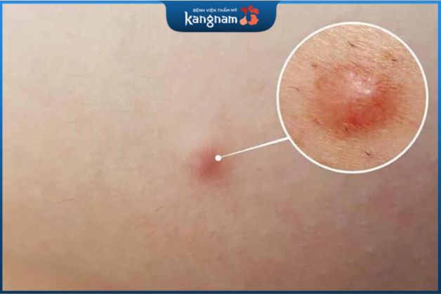 Giai đoạn đầu tiên là sự tăng tiết bã nhờn