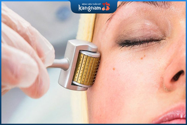 Thực hiện lăn kim giúp tái tạo làn da mới 