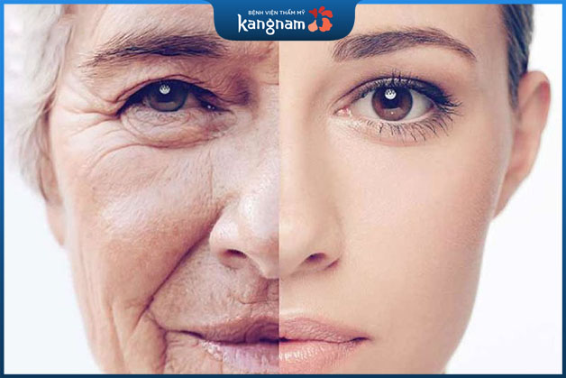 Nâng cơ mặt không cần phẫu thuật diễn ra thực hiện nhanh chóng đem đến hiệu quả cao