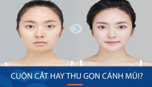 Thời gian hồi phục và kết quả sau cuộn cắt hay thu gọn cánh mũi