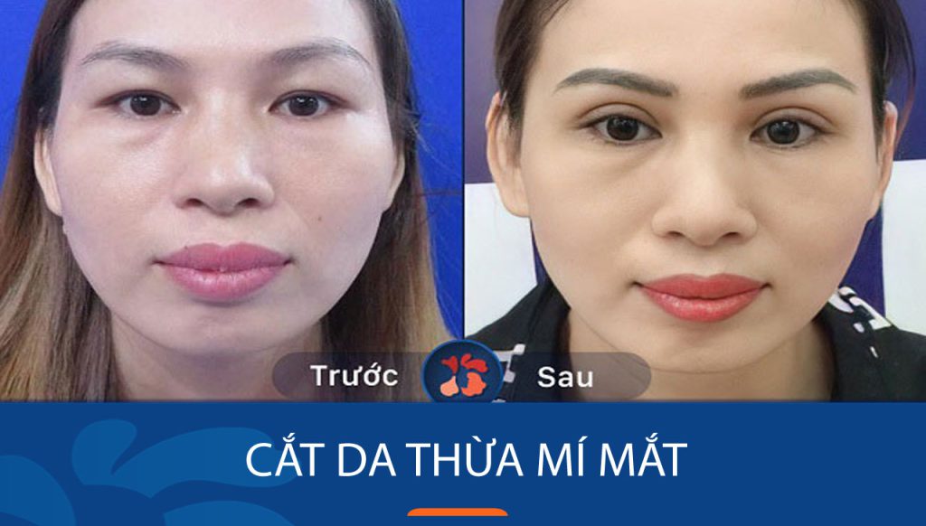 Cắt da thừa mí mắt là gì? Khi nào nên thực hiện và có ảnh hưởng gì không?